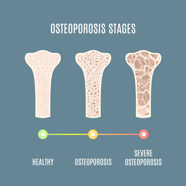 osteoporosis-durham-orthopedic-sports-injury-clinic